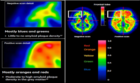 치매 진단 방사성의약품 ‘비자밀(VIZAMYL)’을 이용한 진단 이미지, 컬러가 블루 및 그린인 경우 베타 아밀로이드 신경반 밀도가 거의 없다고 판단하며, 오렌지 및 레드일 경우 중증도 이상의 알츠하이머성 치매일 가능성이 높다.