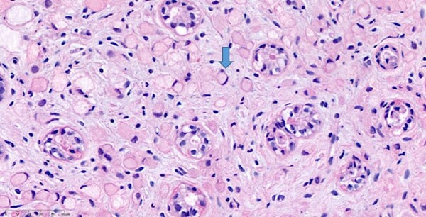 반지세포암. 화살표 부위 세포는 반지 같은 모양이다. 사진 제공=서울성모병원 