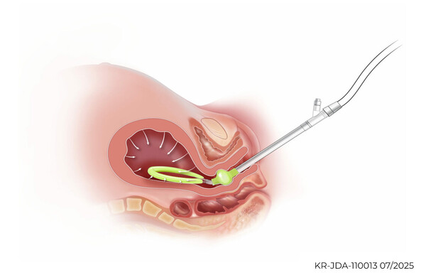 제이다 시스템. 이미지 출처=한국오가논