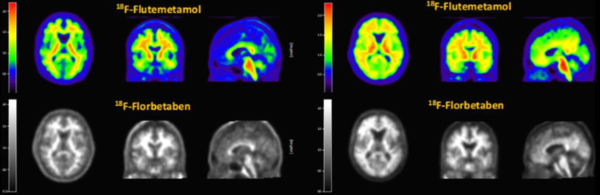 알츠하이머 병 진단을 위한 비자밀(18F-Flutemetamol)과 뉴라체크주사(18F-Florbetaben) PET 영상 비교
