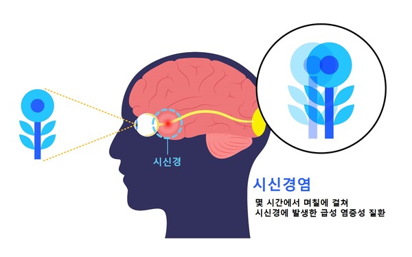 시신경염. 이미지 출처=게티이미지뱅크