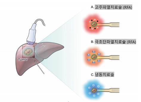 그림. 국소치료술 기술(대한간암학회지 2024)