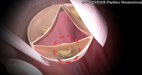 심장 판막에 생긴 유두상 섬유탄성종. 판막이 열렸다 닫힐 때마다 심장종양 부스러기나 심장종양 근처의 혈전이 떨어져 나가 뇌혈관을 막아 뇌졸중을 촉발할 수 있다. 이미지 출처=유튜브 채널 '삼성서울병원' 화면 캡쳐 