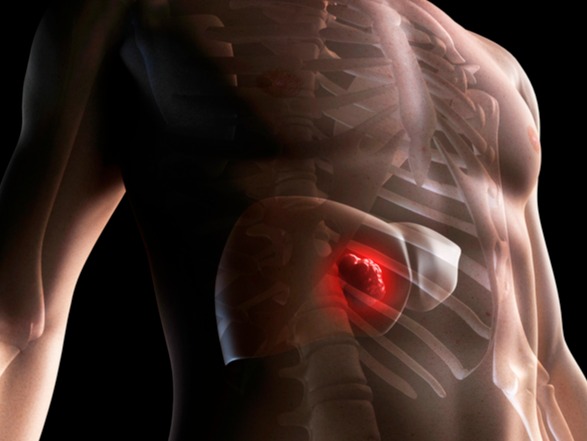 간암 환자는 고기를 많이 먹으면 안 된다는 이야기가 떠돈다. 콩이 들어간 음식도 좋지 않다는 이야기도 있다. 그렇다면 이같은 말이 믿을 만한 사실일까? 이미지 출처=게티이미지