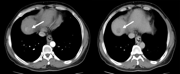 *간암의 CT영상: 53세 남자 환자의 CT영상. 동맥이 보이는 시기(동맥기)에 간의 꼭대기에 조영증강되어 하얗게 보이는 종괴가 있다(화살표). 간 문맥이 보이는 시기(문맥기)에 병변에서 조영제가 빠져나가 저음영 병변으로 보인다(화살표).