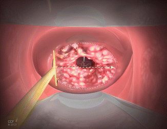 자궁경부 원추절제술(출처: https://encyclopedia.pub/entry/history/show/77286)