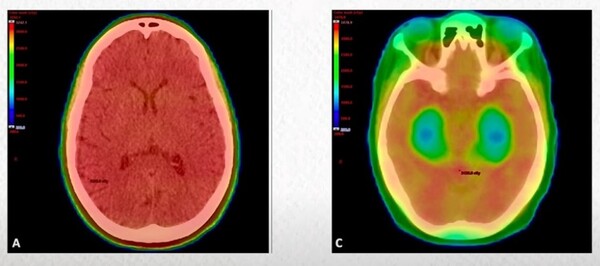 사진 출처=유튜브 채널 '폐암 무엇이든 물어보세요' 캡쳐