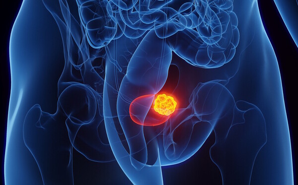 식약처는 지난 12일 유두종 유무에 상관없이 상피내암(CIS)을 가진 BCG-불응 고위험 비근침습성 방광암(NMIBC) 치료에 두 종의 치료제를 각각 희귀의약품과 개발단계 희귀의약품으로 지정했다. 이미지 출처=게티이미지