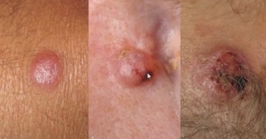 ​메르켈암의 여러 유형. 사진 출처=한국혈액암협회 유튜브 채널 'KBDCA'