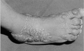 황색종. 사진 출처=소아 희귀질환 치료제 접근성 강화를 위한 국회 정책토론회 자료집