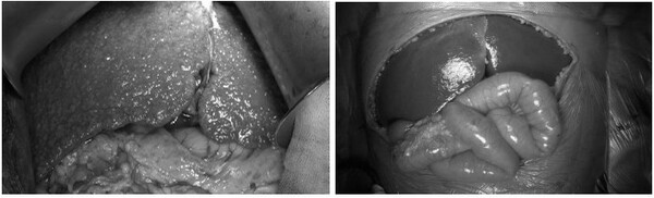 생후 6개월 된 진행성가족성간내답즙정체증 환아의 간과 정상 간의 모습. 사진 출처=소아 희귀질환 치료제 접근성 강화를 위한 국회 정책토론회 자료집