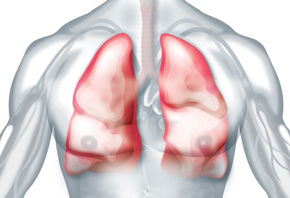 폐암. 이미지 출처=게티이미지