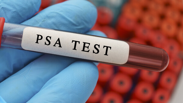 전립선특이항원(Prostate Specific Antigen, PSA) 수치가 높아져 있어 MRI 검사를 했고 그 뒤 조직검사까지 해서 전립선암 진단을 받아 모든 치료를 끝냈는데, 여전히 PSA 수치가 높게 나오는 사람이 있다. 왜 그런 것일까? 이미지 출처=게티이미지