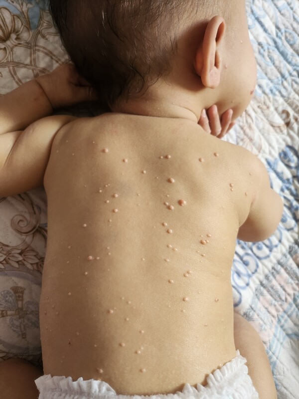 지방종. 사진 제공=김나영 대표