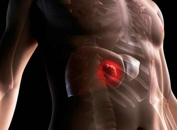 사진 출처 :게티이미지(간암)