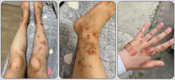 김수진 씨의 실제 병변 모습. 사진 제공=김수진 씨